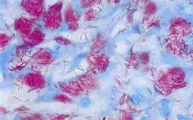Leprosy Etiology Pathogenesis And Lab Diagnosis Learn Microbiology Online