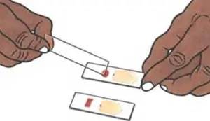 Preparation of Thick and Thin Blood Smear