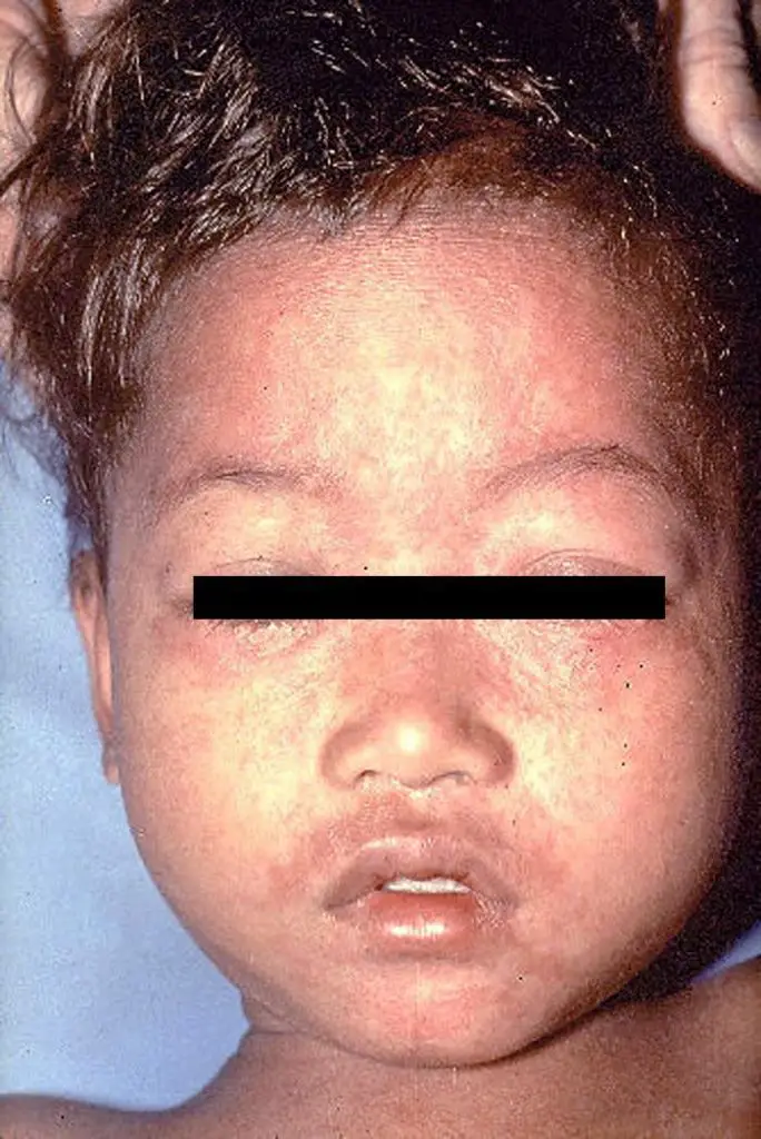 Measles infected child