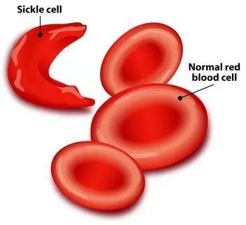 Relationship between sickle cell anemia and malaria