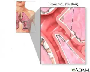 Bronchiolitis Image source: US National library of medicine