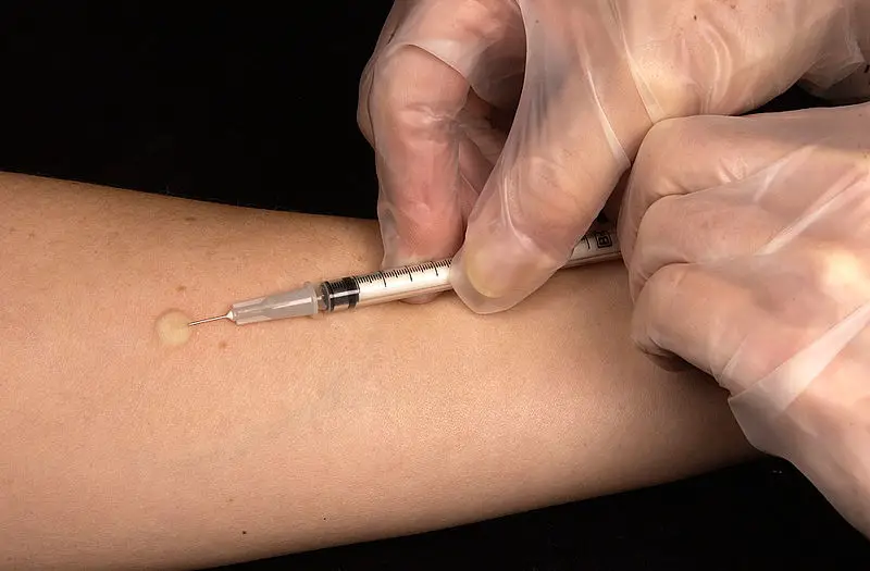 Mantoux tuberculin test