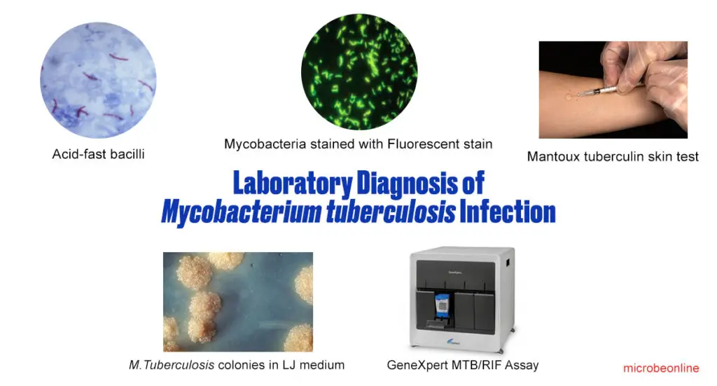 laboratory-diagnosis of Mycobacterium tuberculosis infection