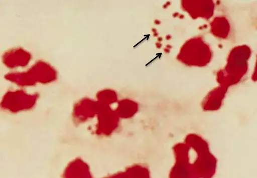 Gram stain of N. meningitidis in CSF