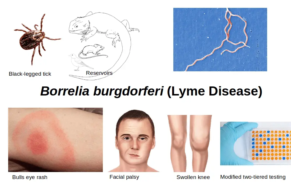 Borrelia burgdorferi (Lyme disease): Clinical Features, Diagnosis