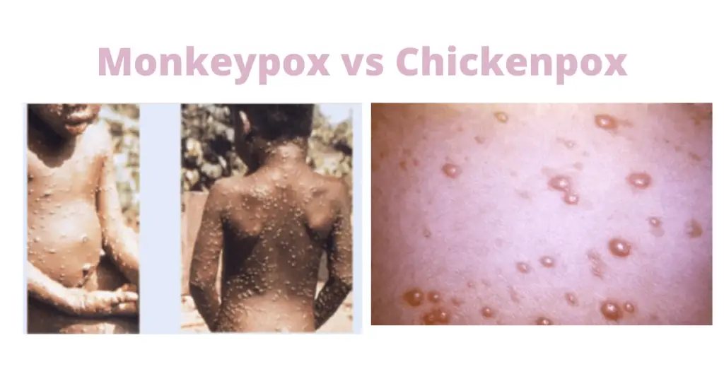 Monkeypox vs chickenpox