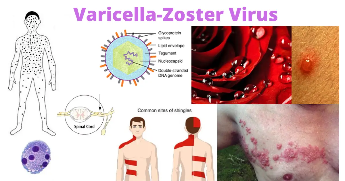 Varicella-Zoster Virus (VZV): Chicken Pox and Shingles