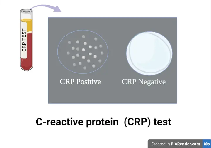C-reactive protein (CRP) Test: Principle, Procedure, Result