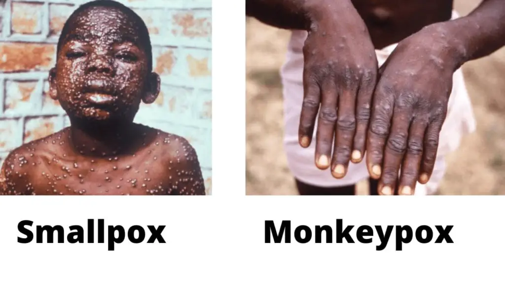 difference between smallpox and monkeypox
