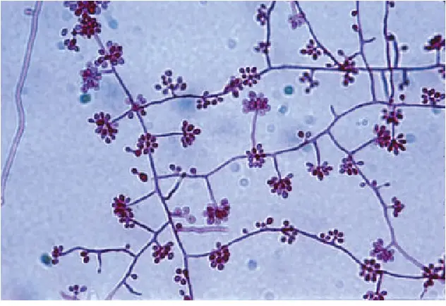 Mold phase of S. schenckii mounted on Parker-Quink stain showing thin septated hyphae with right-angled conidiophores and ovoid-shaped conidia in a “rosette”-like arrangement. Reproduced with permission from A/Prof. David Ellis, University of Adelaide.
