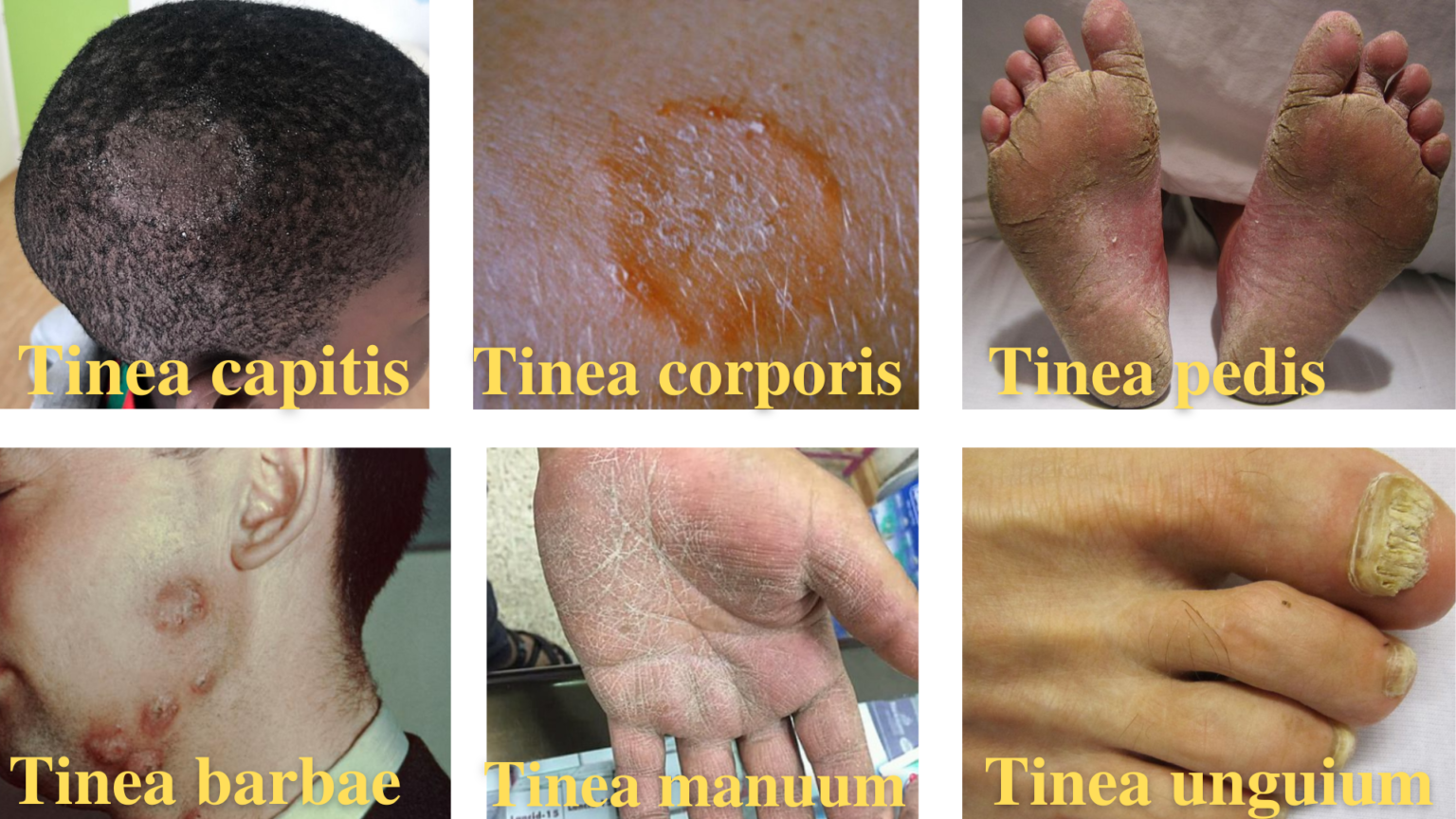 Dermatophytes Tinea And Lab Diagnosis • Microbe Online 1944